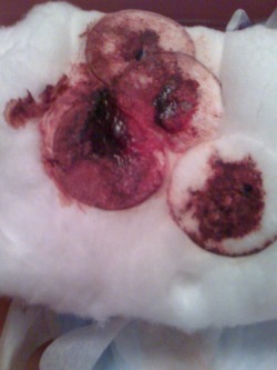 postpartum bleeding clots